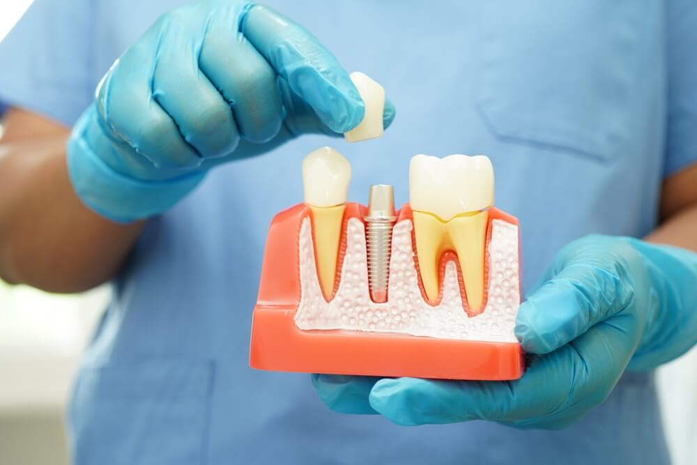 A Tony Hill Dental dentist holding a dental implant model